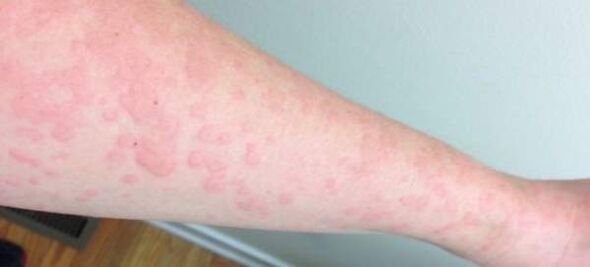 Odos alergija yra parazitų buvimo organizme požymis